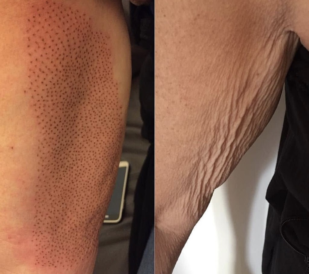 Plasma Skin Regeneration | 00 Ranch Gate, Strathmore, AB T1P 0B4, Canada | Phone: (403) 901-4663