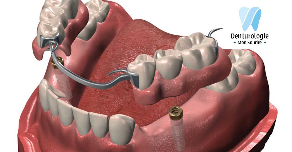 Denturologie Mon Sourire I Denturologiste Saint Laurent | 2505 Rue des Nations, Saint-Laurent, QC H4R 3C8, Canada | Phone: (514) 506-4983