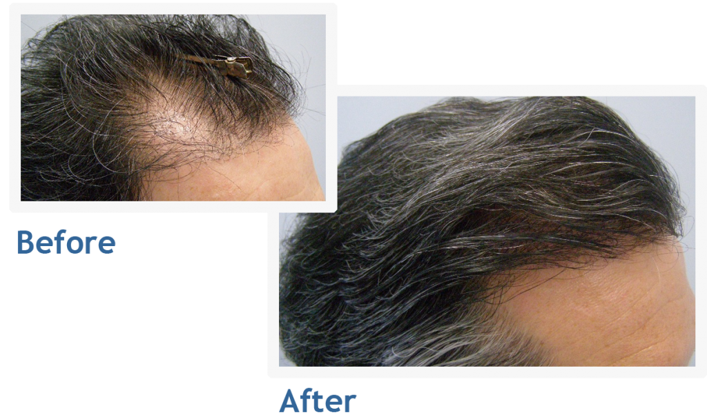 NuHair Medical Hair Transplant Centre | 4040 Veterans Pl NW Unit 200, Calgary, AB T3B 3R7, Canada | Phone: (403) 923-5954