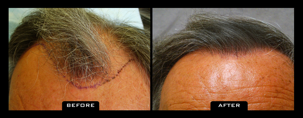 NuHair Medical Hair Transplant Centre | 5526 111 St NW, Edmonton, AB T6H 3E9, Canada | Phone: (587) 400-0344
