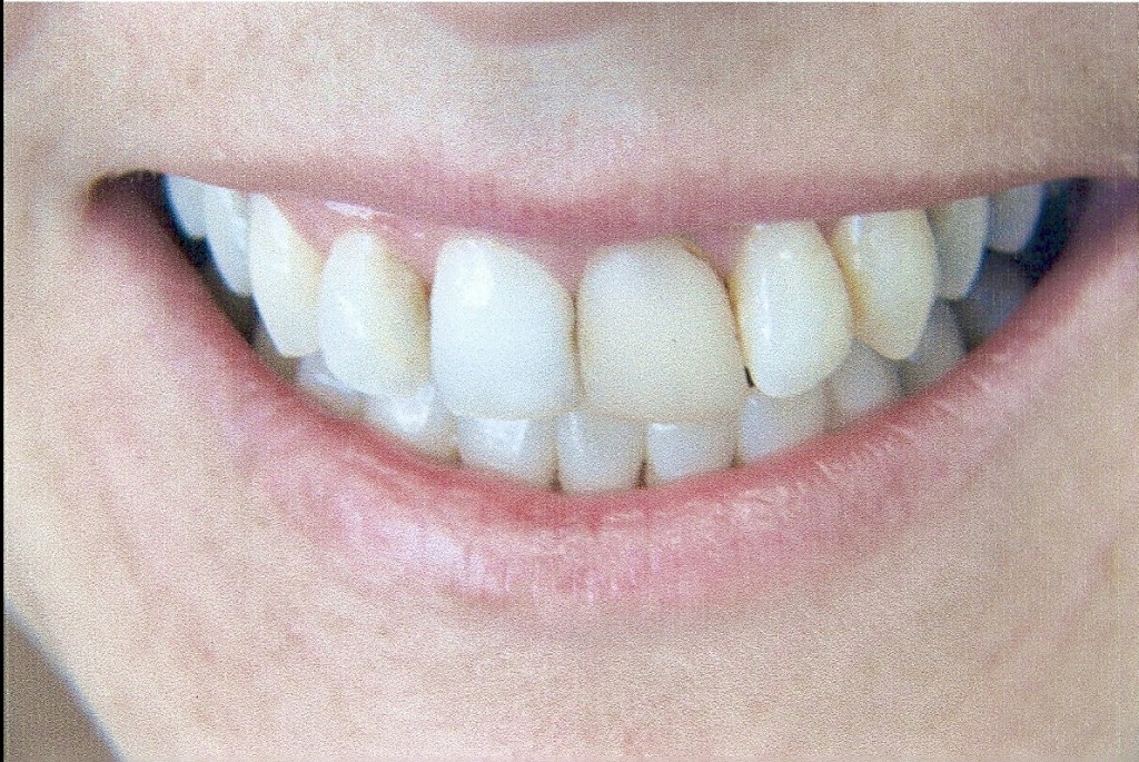 Cad Crowns Ca Inc | 210-1580 Merivale Rd, Nepean, ON K2G 4B5, Canada | Phone: (613) 723-7300