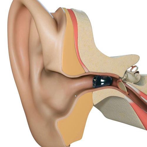 Robillard Hearing Centres | 1934 St Joseph Blvd, Orléans, ON K1C 1E4, Canada | Phone: (613) 837-7555