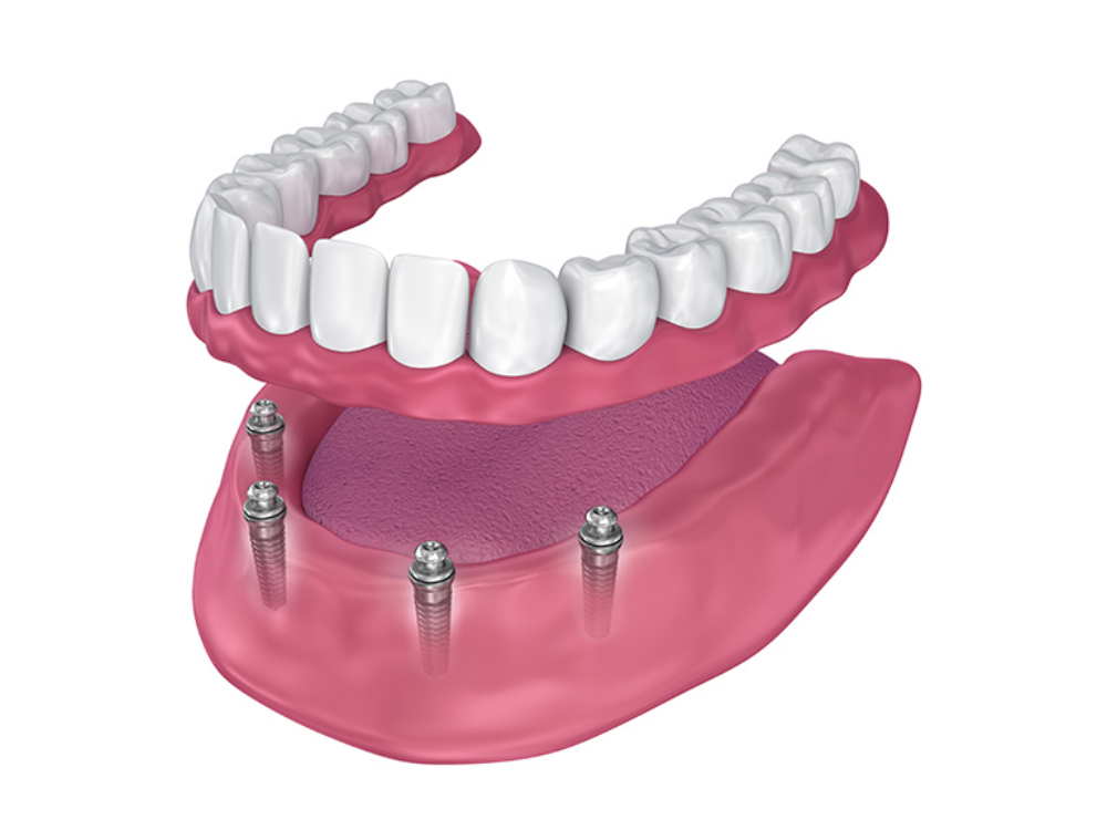 Nathalie Côté Denturologiste | 1380 Chemin de la Bataille N, La Prairie, QC J5R 0K8, Canada | Phone: (450) 444-7727