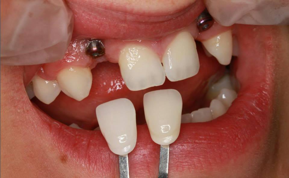 J169 Dental Design Inc | 181 Sablewood Rd, Winnipeg, MB R3Y 0H8, Canada | Phone: (204) 417-2924