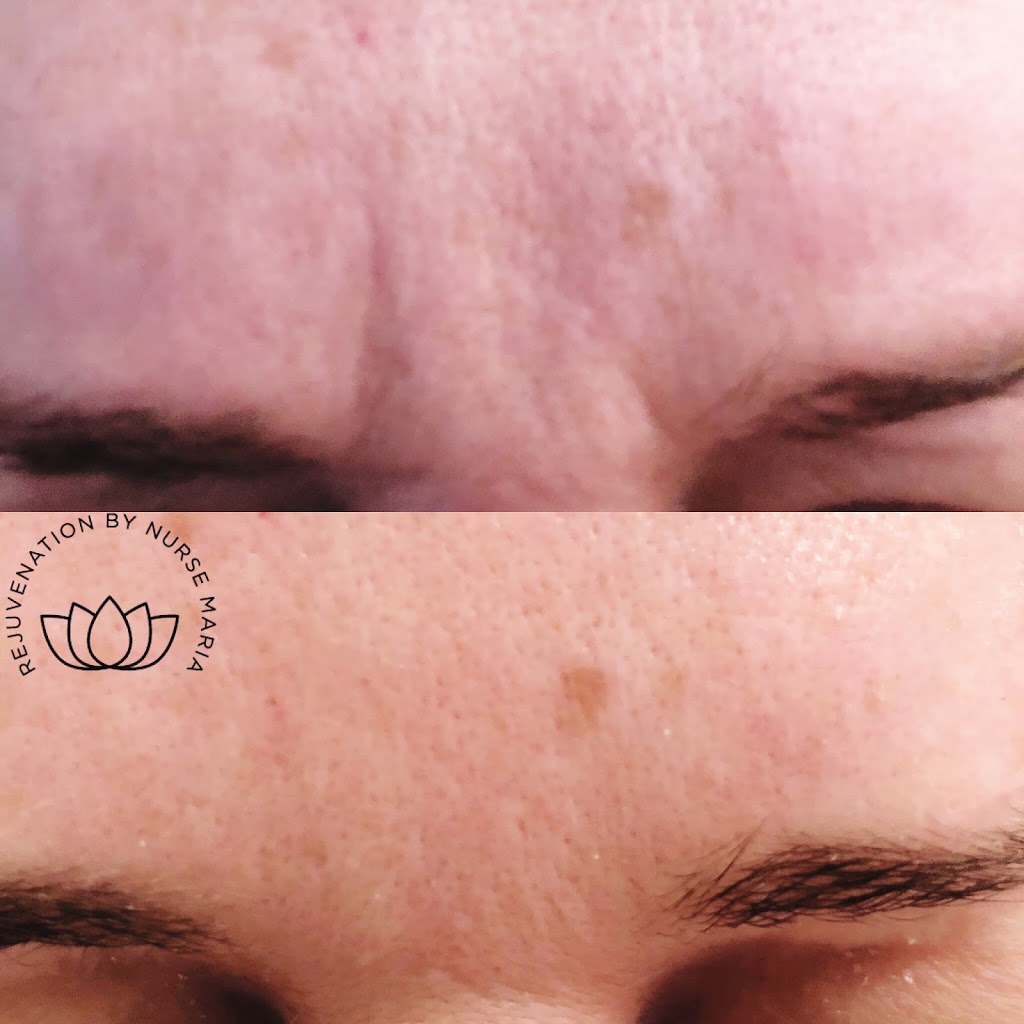New Tec Cosmetic Rejuvenation | 35 Wolfe Ave Tottenham L0G1W0, 100 Bass Pro Mills Dr Unit 42, Vaughan, ON L4K 5X1, Canada | Phone: (416) 605-3646