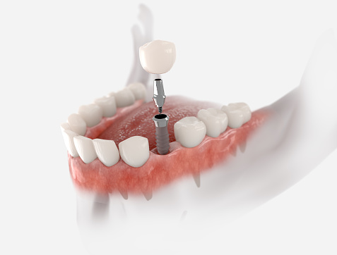 Francois Pepin d.d. denturologiste Montréal-Nord | 5900 Bd Léger Suite 101, Montréal, QC H1G 1K9, Canada | Phone: (514) 329-4376