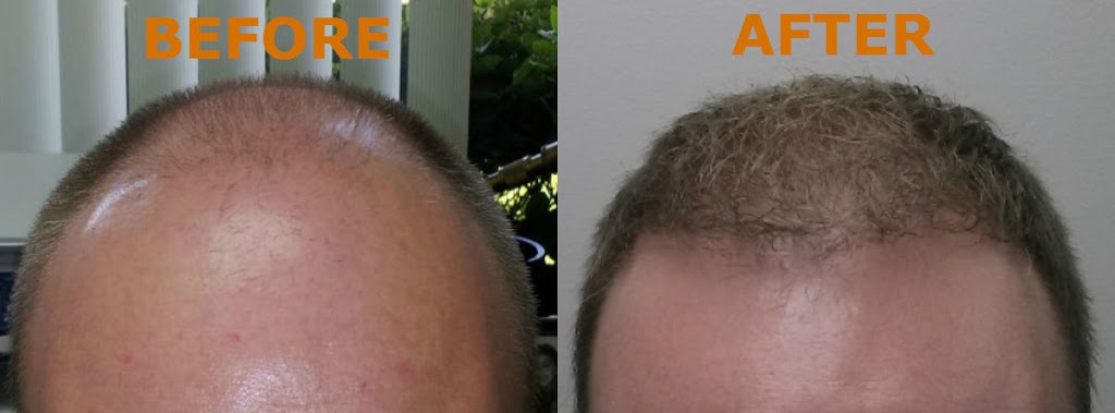 Buffalo Hair Transplant Center | 5007 Transit Rd Suite #2, Depew, NY 14043, USA | Phone: (716) 226-1020
