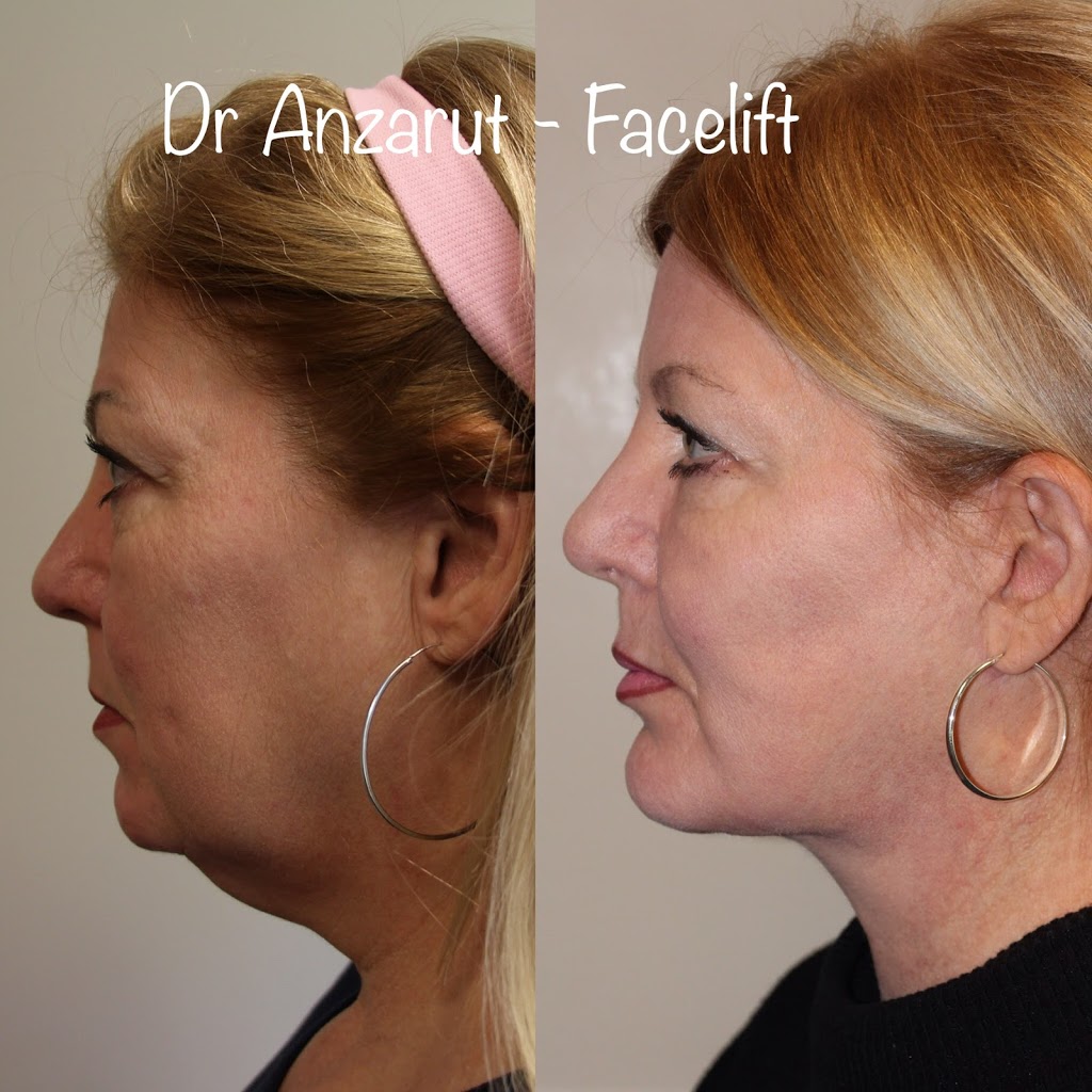 Dr Anzarut Plastic Surgery | 2763 Beverly St Suite 201b, Duncan, BC V9L 6X2, Canada | Phone: (250) 597-2064