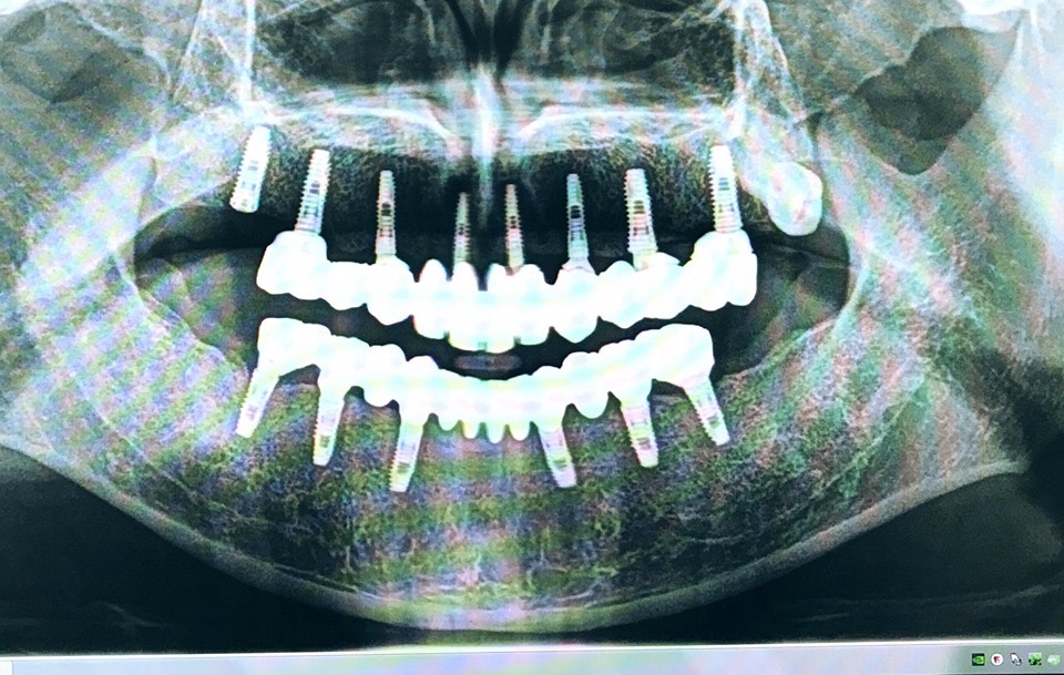 Bellwether Dental Implants & Oral Surgery | 12 Bellwether Way Ste 114, Bellingham, WA 98225, USA | Phone: (360) 366-8026