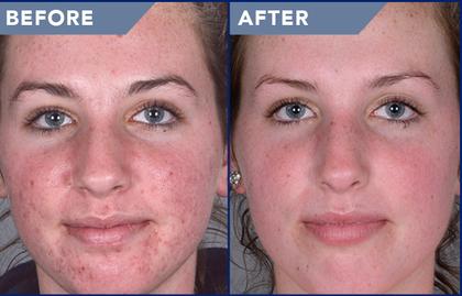 Viore Laser Medspa | 2786 W 16th Ave Unit 207, Vancouver, BC V6K 4M1, Canada | Phone: (604) 653-8014