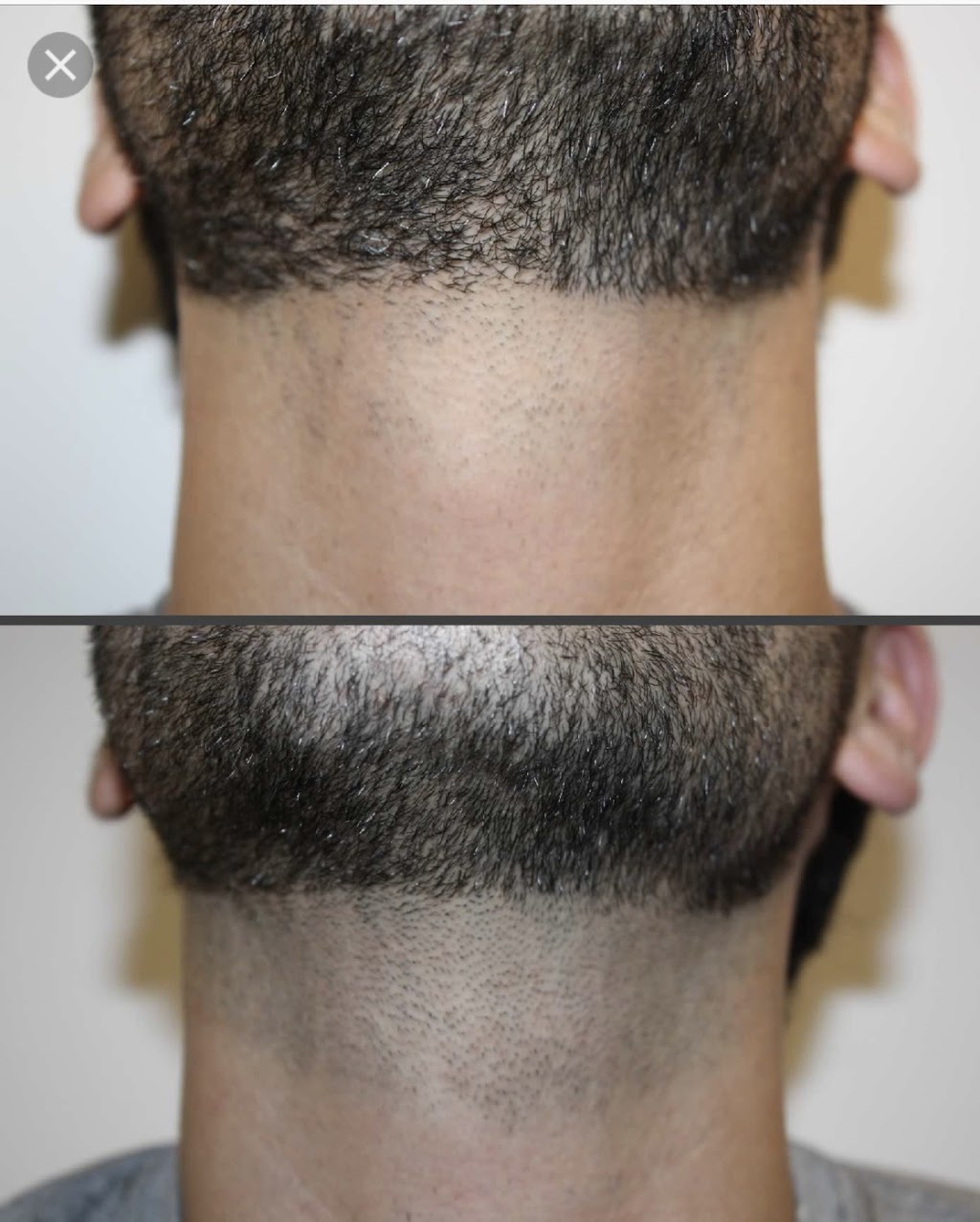 ABLC - Advanced Body & Laser Center | 165 Windham Ln, Grand Island, NY 14072, USA | Phone: (716) 628-7649