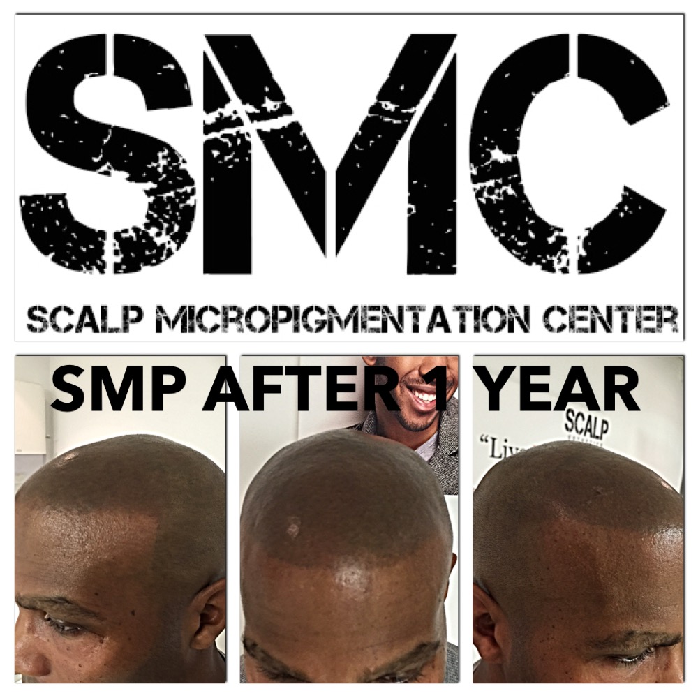 Scalp Micropigmentation London | 328 Glenrose Dr, London, ON N6K 2A8, Canada | Phone: (519) 881-6044