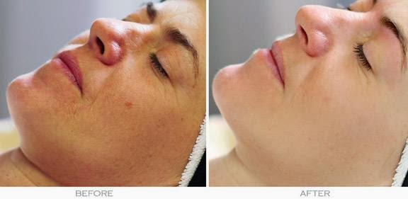 Odettes Skin Laser Wellness Clinic | 31 - 10042 Main Street, Lake Country, BC V4V 1P6, Canada | Phone: (250) 765-7892