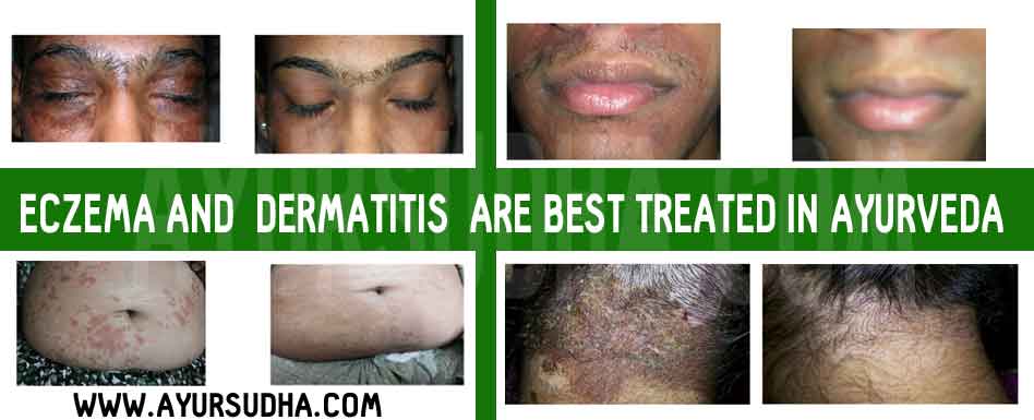 AYUR - SUDHA :: AYURVEDIC CENTRE CANADA | 2250 Bovaird Dr E Suite # 515, Brampton, ON L6R 0W3, Canada | Phone: (647) 685-6946
