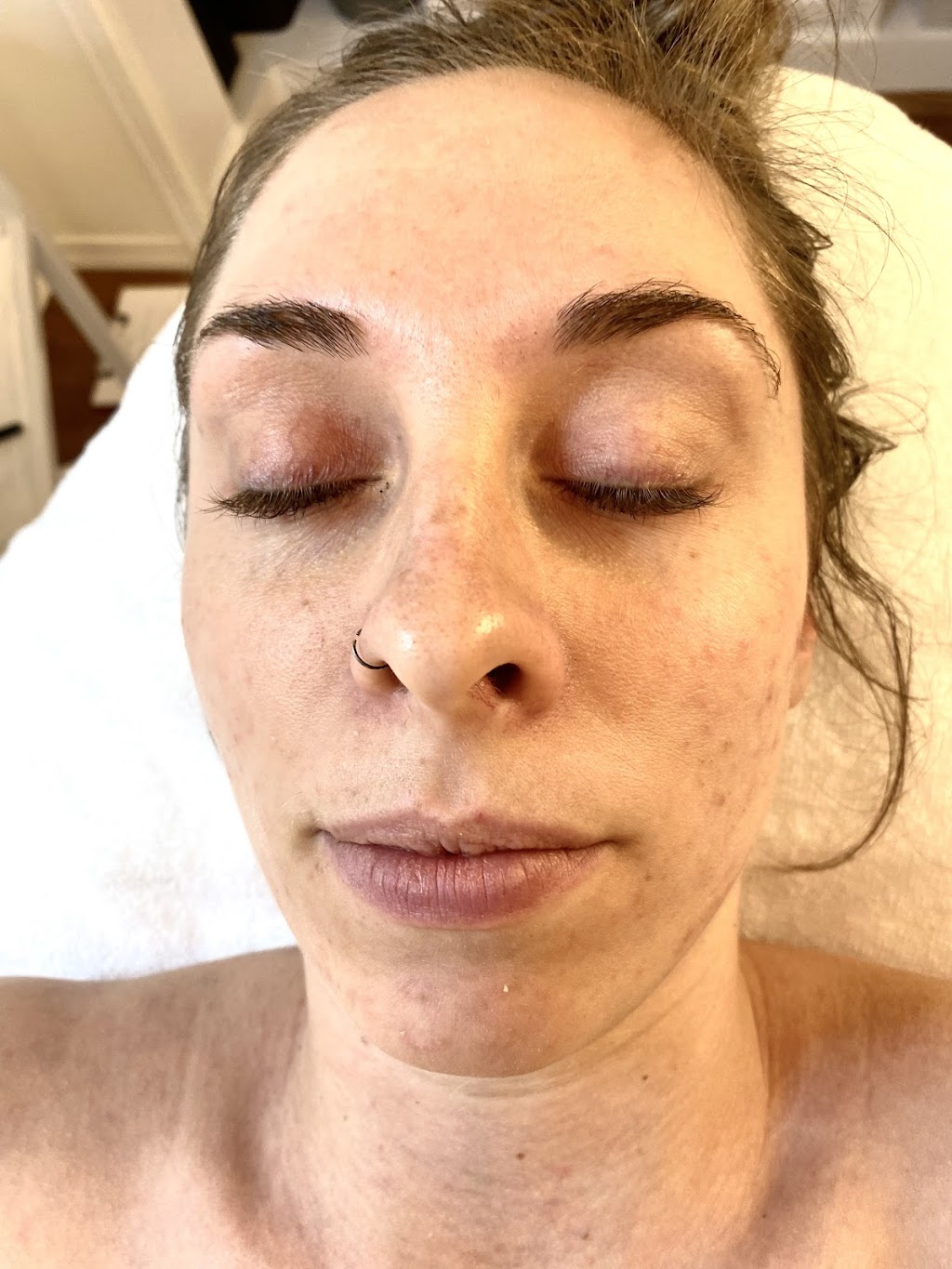 Luminate Derm Spa | 130 Bainbridge Crescent NW, Edmonton, AB T5T 6B4, Canada | Phone: (780) 266-8449