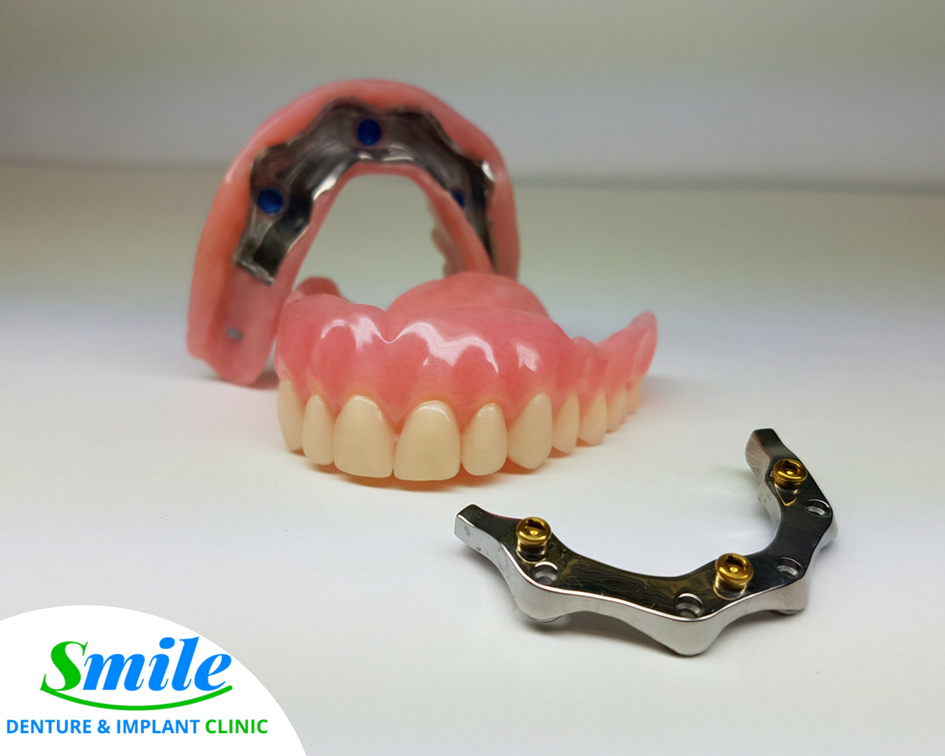 Smile Denture & Implant Clinic | 1825 Woodward Dr, Ottawa, ON K2C 0P9, Canada | Phone: (613) 702-2656