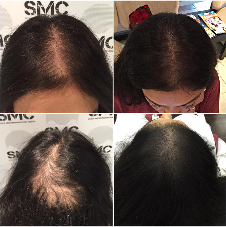 Scalp Micropigmentation London | 328 Glenrose Dr, London, ON N6K 2A8, Canada | Phone: (519) 881-6044