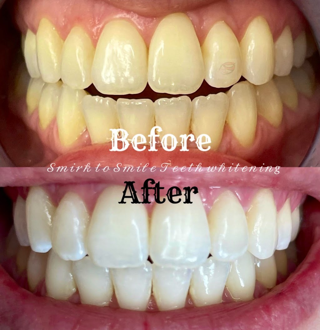 Smirk to Smile Teeth Whitening | 10 Jensen Crescent NE, Airdrie, AB T4B 1P4, Canada | Phone: (403) 404-1421