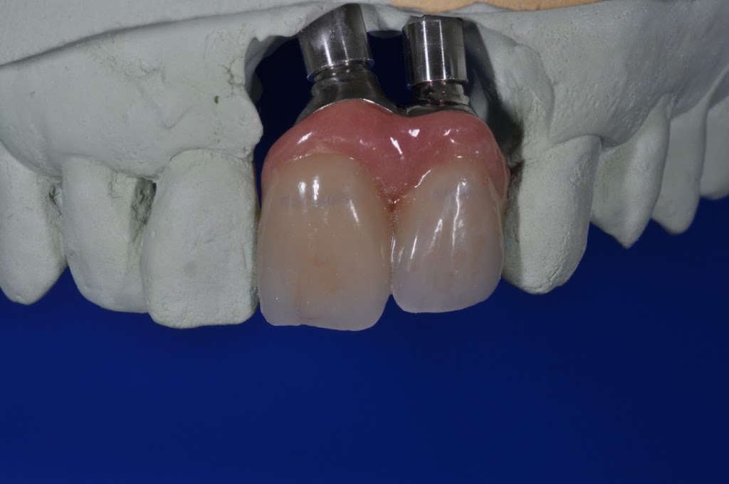 Cad Crowns Ca Inc | 210-1580 Merivale Rd, Nepean, ON K2G 4B5, Canada | Phone: (613) 723-7300