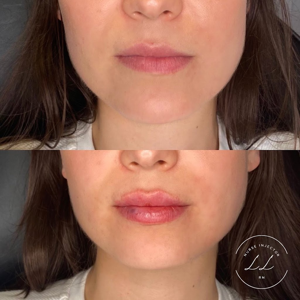 Lauren Landry RN - Halifax Injector: Botox and Dermal Fillers | 6461 Quinpool Rd, Halifax, NS B3L 1B1, Canada | Phone: (902) 789-1174