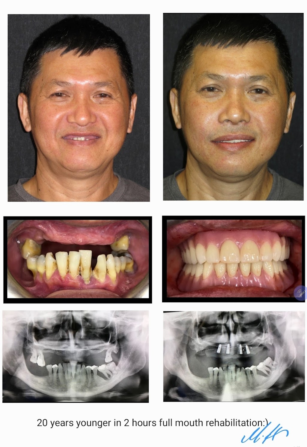 Erin Mills Smiles Dentistry | 5100 Erin Mills Pkwy Unit 107, Mississauga, ON L5M 4Z5, Canada | Phone: (289) 724-2700