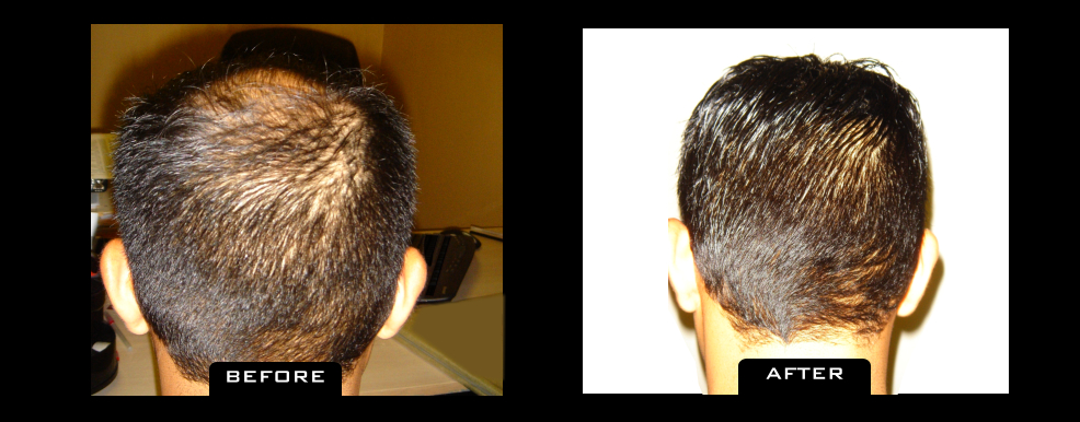 NuHair Medical Hair Transplant Centre | 4040 Veterans Pl NW Unit 200, Calgary, AB T3B 3R7, Canada | Phone: (403) 923-5954