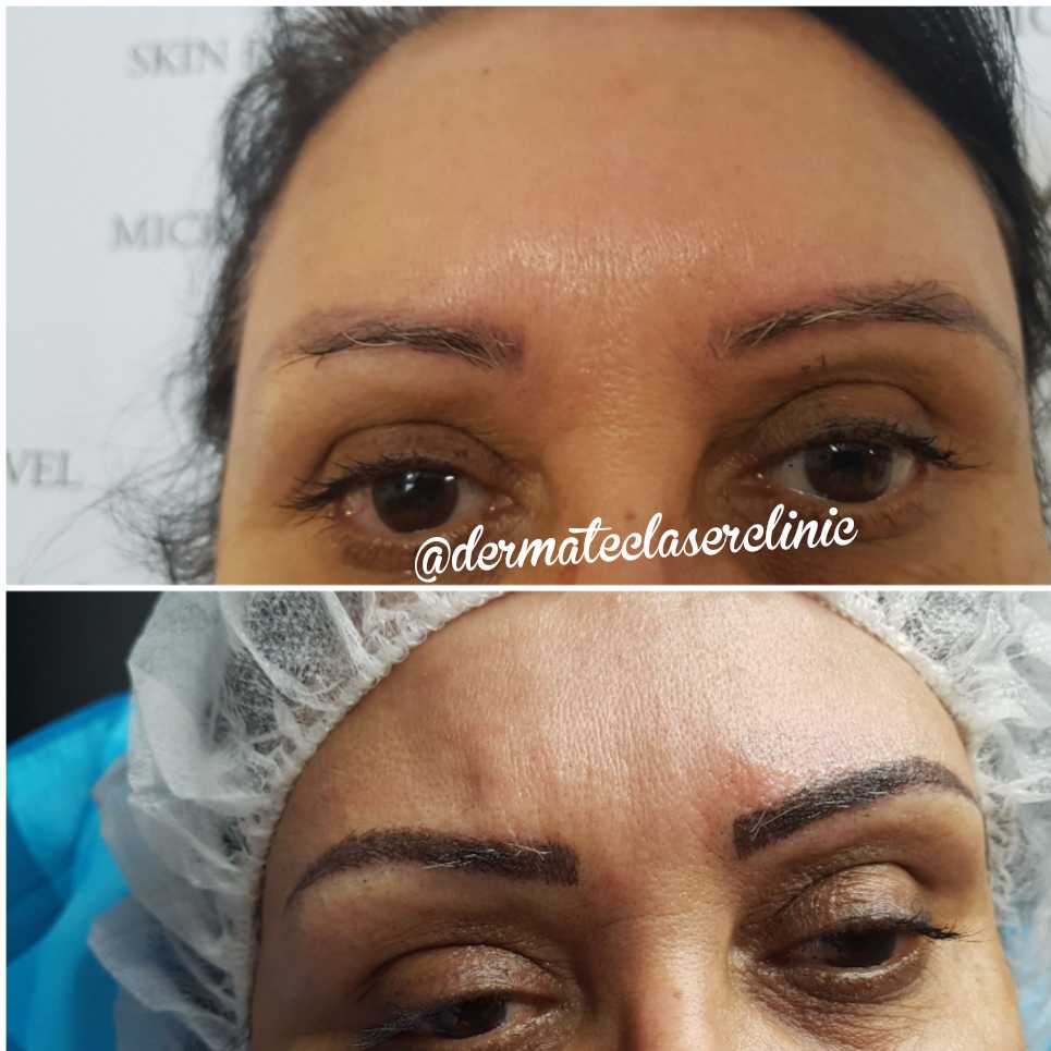 Dermatec Permanent Cosmetic and Laser Clinic | 6499 122a St, Surrey, BC V3W 3R8, Canada | Phone: (604) 805-4273