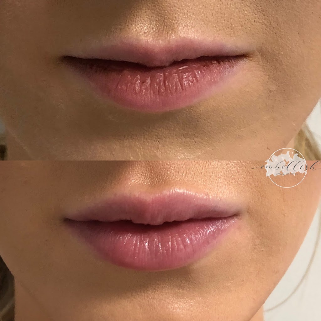 Embellish Medical Aesthetics | 1201 Larry Uteck Blvd #103, Bedford, NS B4B 0S9, Canada | Phone: (902) 240-5750