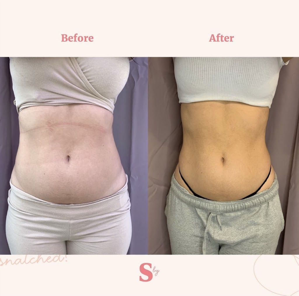 Snatched by Ale Fat Freezing | 59 Cathedral High St Unit 1, Markham, ON L6C 0P1, Canada | Phone: (647) 806-5353