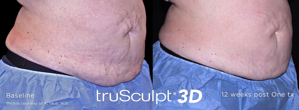 Smooth Laser Clinic and Body Sculpting | 14885 60 Ave #6, Surrey, BC V3S 1R8, Canada | Phone: (604) 593-5578