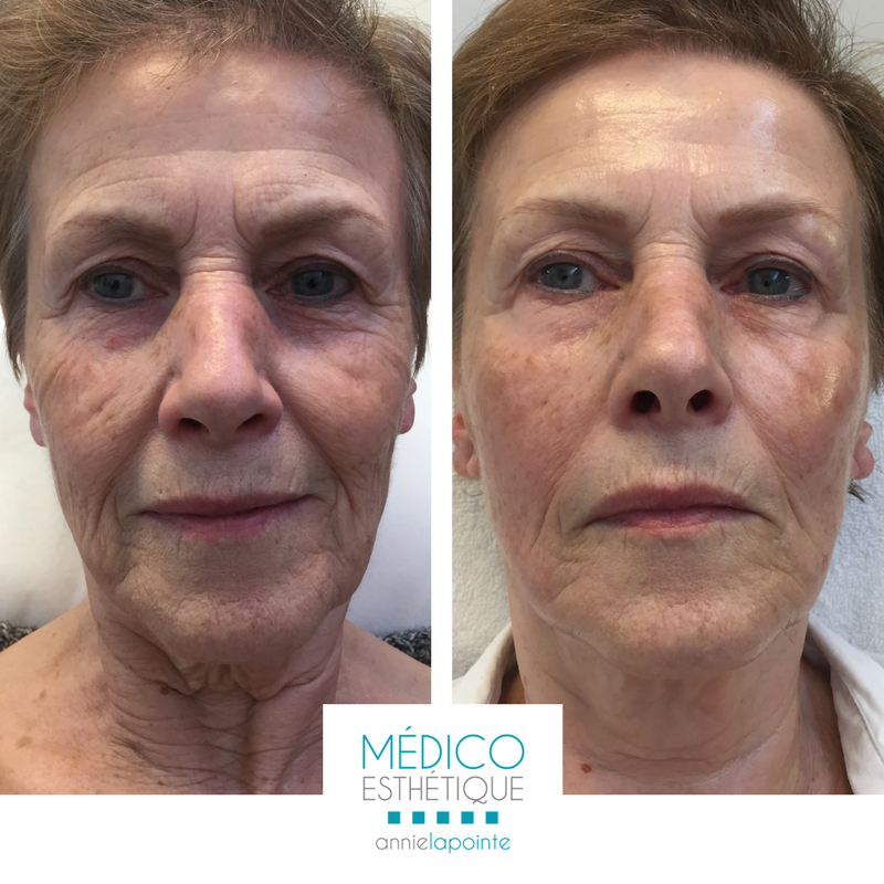 Médico Esthétique Annie Lapointe | 700 Route du Président-Kennedy, Pintendre, QC G6C 1E2, Canada | Phone: (418) 951-6285