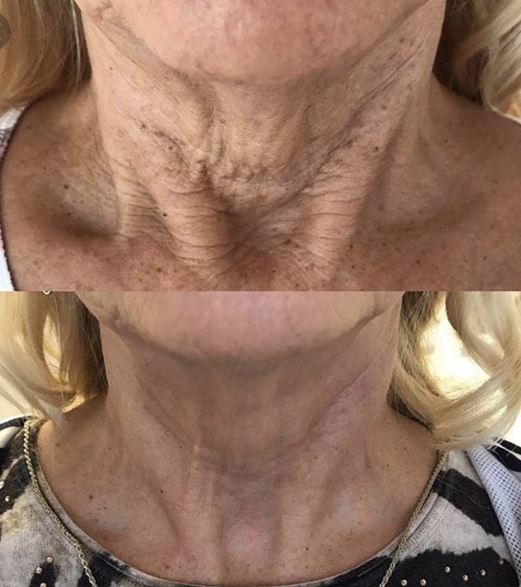 Plasma Skin Regeneration | 00 Ranch Gate, Strathmore, AB T1P 0B4, Canada | Phone: (403) 901-4663