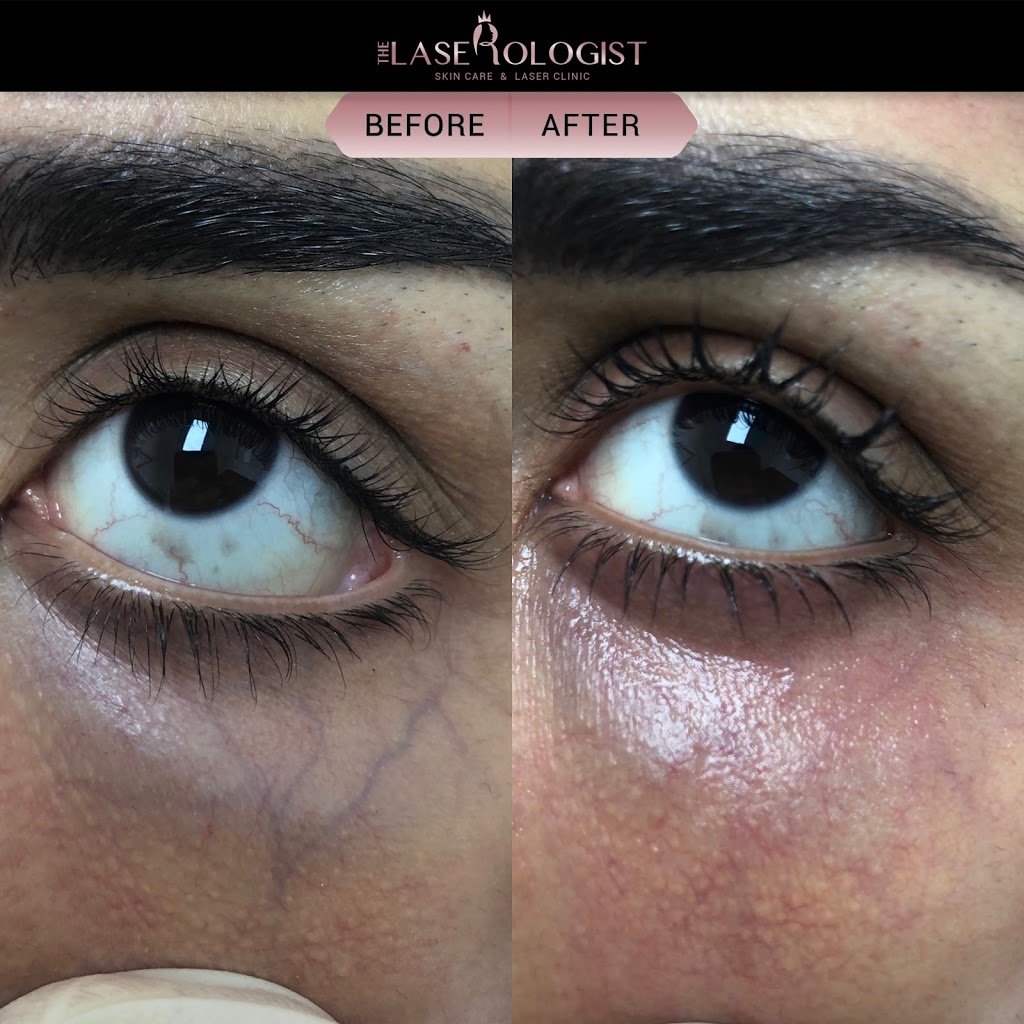 The Laserologist | 69 Bethune Ave, Hannon, ON L0R 1P0, Canada | Phone: (905) 519-7232