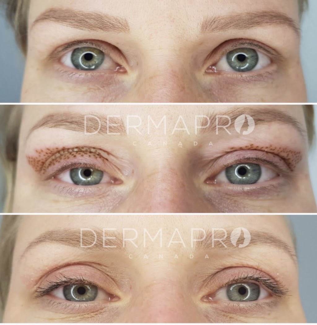 Plasma Skin Regeneration | 00 Ranch Gate, Strathmore, AB T1P 0B4, Canada | Phone: (403) 901-4663