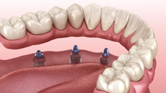 Denturo-Tech | 220 Rue Notre Dame, Donnacona, QC G3M 1G5, Canada | Phone: (418) 931-5262