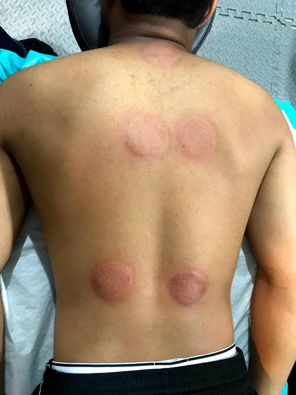 Holistic Hijama Benefits | 3915 Baggins Ct, Mississauga, ON L5N 7A3, Canada | Phone: (416) 388-5036