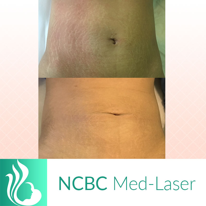 NCBC Med-Laser | hair care | 2090 Lawrence Ave E, Scarborough, ON M1R 2Z5, Canada | 4169314772 OR +1 416-931-4772