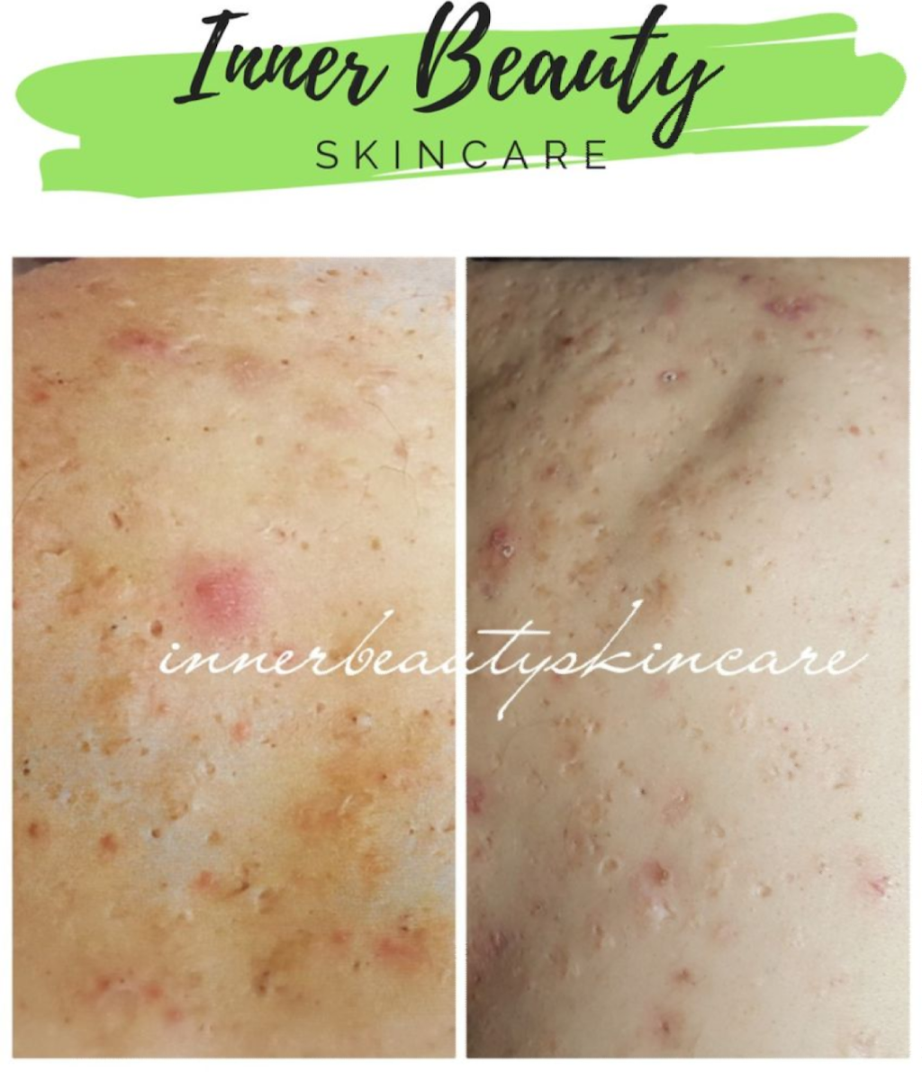 Inner Beauty Skincare Spa | 2612 Main St, Newfane, NY 14108, USA | Phone: (716) 946-3820