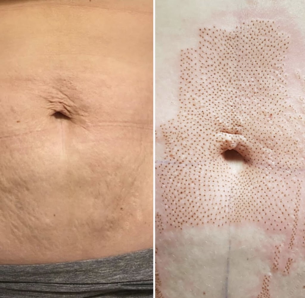 Plasma Skin Regeneration | 00 Ranch Gate, Strathmore, AB T1P 0B4, Canada | Phone: (403) 901-4663