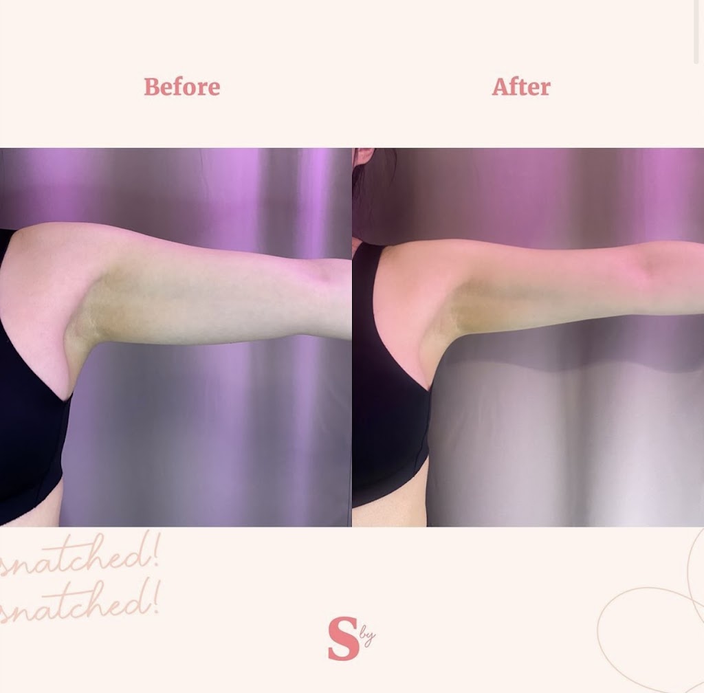 Snatched by Ale Fat Freezing | 59 Cathedral High St Unit 1, Markham, ON L6C 0P1, Canada | Phone: (647) 806-5353