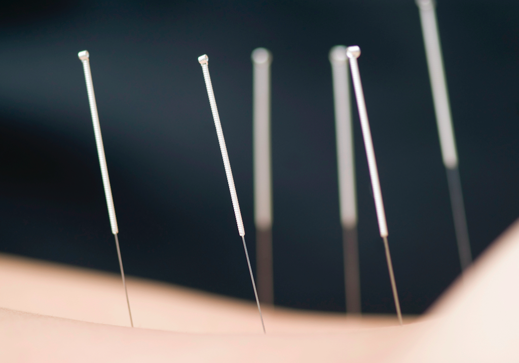 Acupuncture Rachel Cavanagh - Blainville | 49 Rue Émilien Marcoux, Blainville, QC J7C 0B4, Canada | Phone: (514) 823-1361