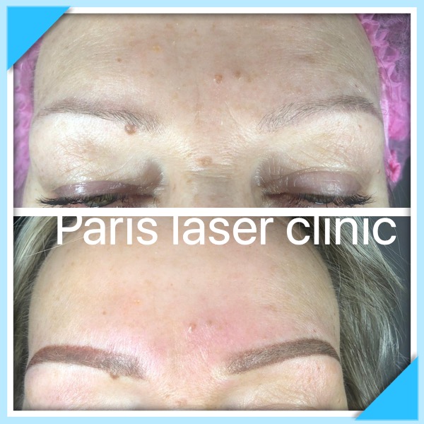 The Paris Laser Clinic | 10970 Bramalea Rd, Brampton, ON L6R 0C1, Canada | Phone: (647) 327-2747
