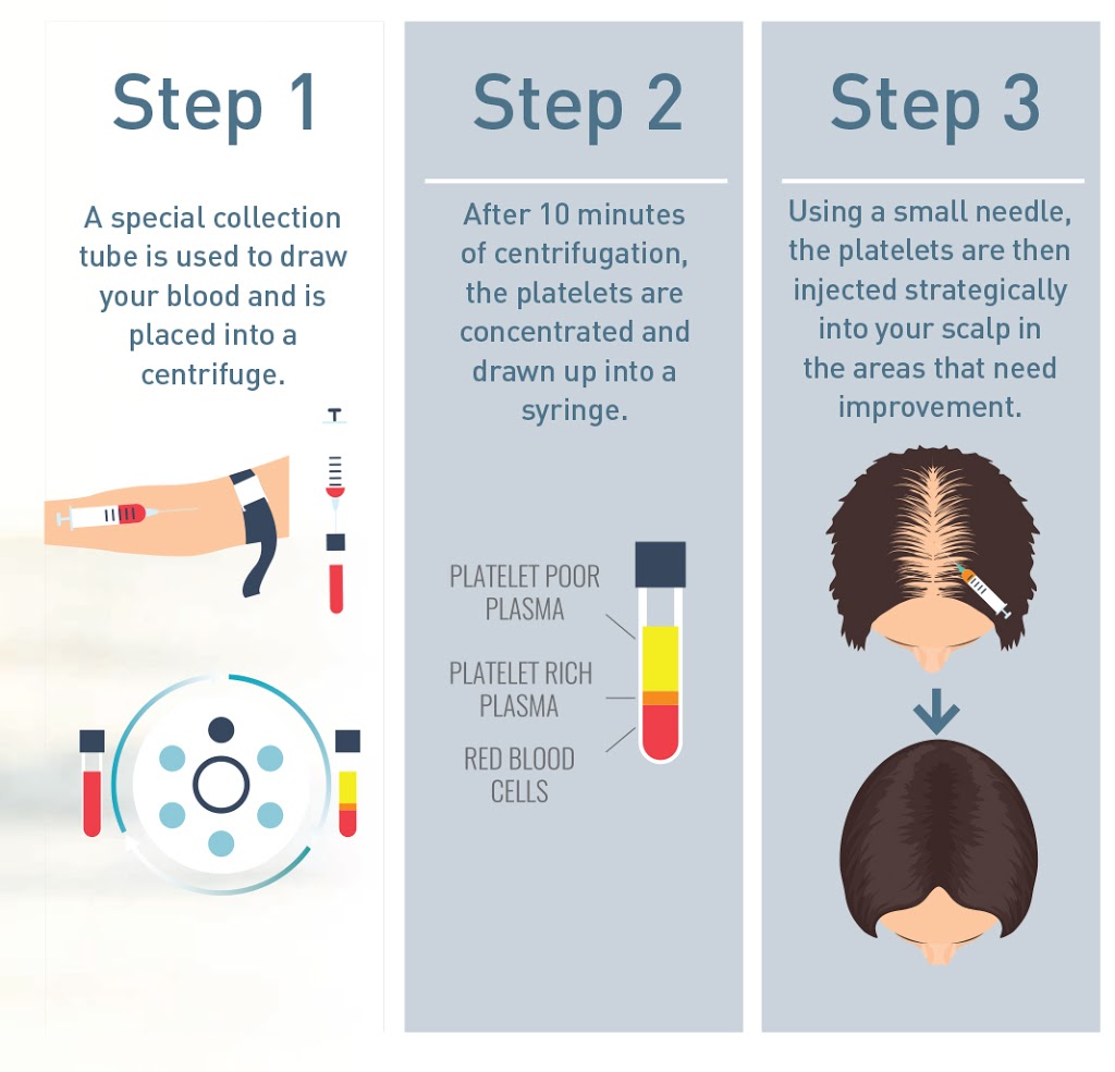 Aurora Hair Loss Clinic | 372 Hollandview Trail unit 302, Aurora, ON L4G 0A5, Canada | Phone: (905) 503-4001