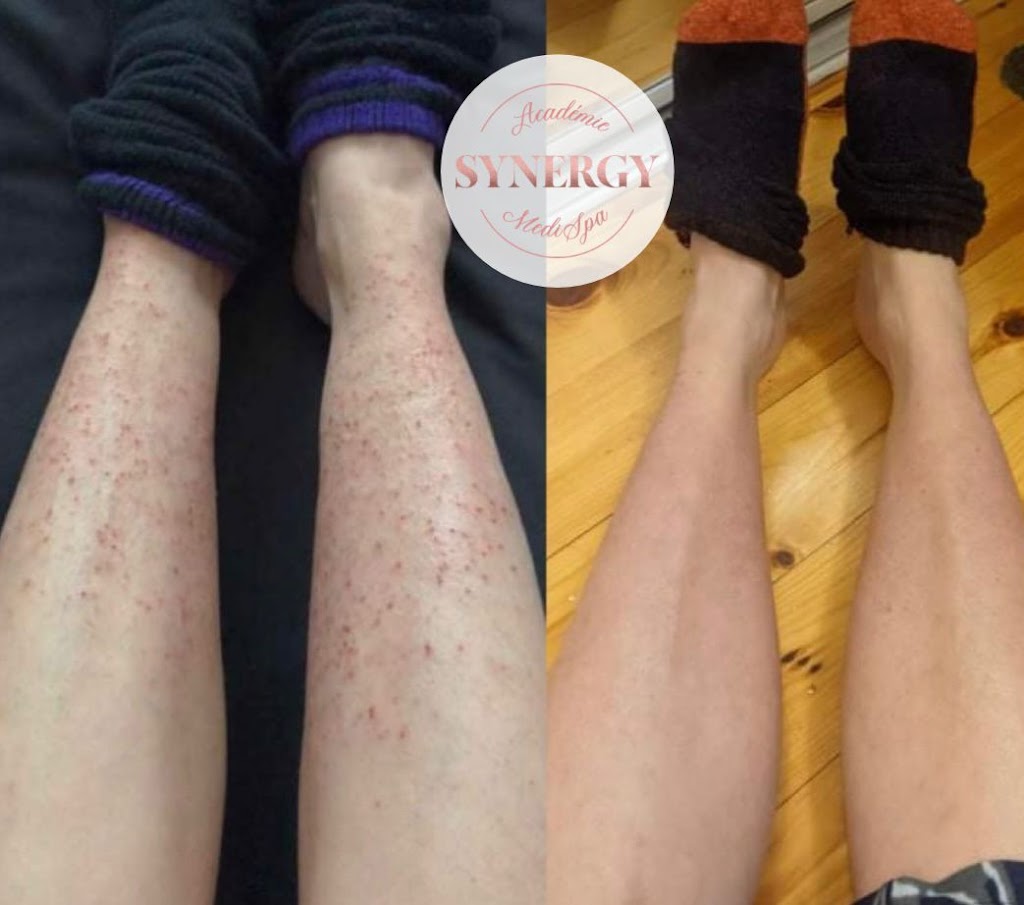 Synergy Medispa | Pointe-Claire | 183E Boul Hymus, Pointe-Claire, QC H9R 1E9, Canada | Phone: (514) 886-4681