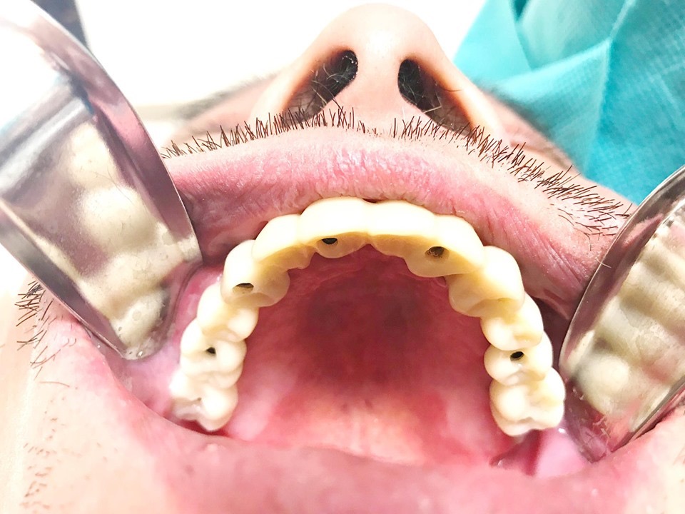 Bellwether Dental Implants & Oral Surgery | 12 Bellwether Way Ste 114, Bellingham, WA 98225, USA | Phone: (360) 366-8026
