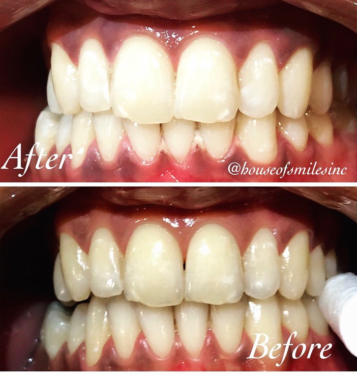 House of Smiles Teeth Whitening Inc. | 442 Lockmaster Crescent, Manotick, ON K4M 1L9, Canada | Phone: (613) 620-3504