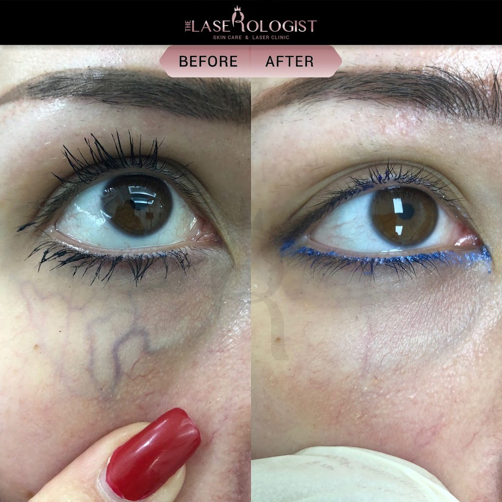 The Laserologist | 69 Bethune Ave, Hannon, ON L0R 1P0, Canada | Phone: (905) 519-7232
