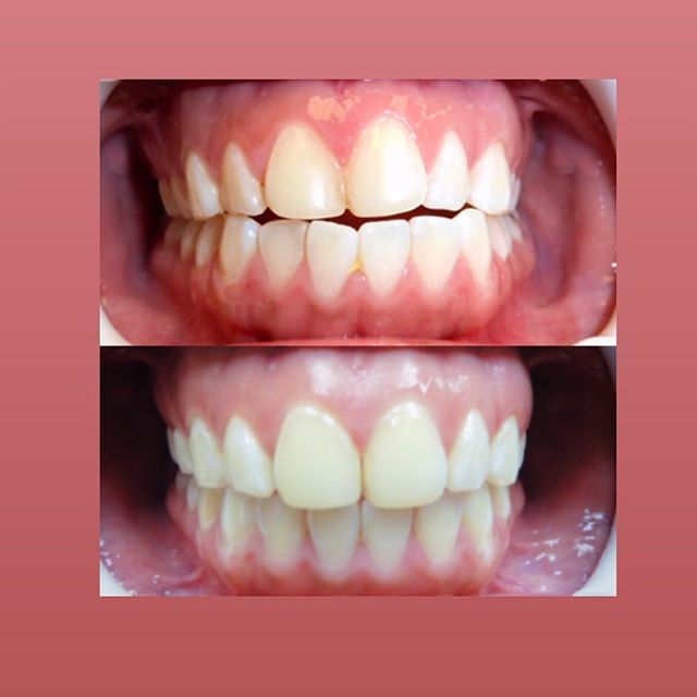 Oak Ridges North Dental Office, Richmond hill | 13311 Yonge St #106, Richmond Hill, ON L4E 3L6, Canada | Phone: (905) 773-7773
