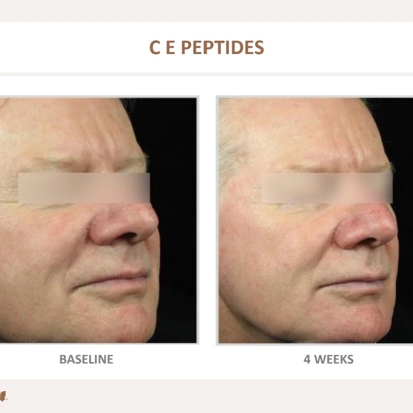 NuSkin Cosmetic Laser Clinic | Call for locations near you, 9991 Hwy 7, Kawartha Lakes, ON K9H 0A1, Canada | Phone: (705) 991-4767
