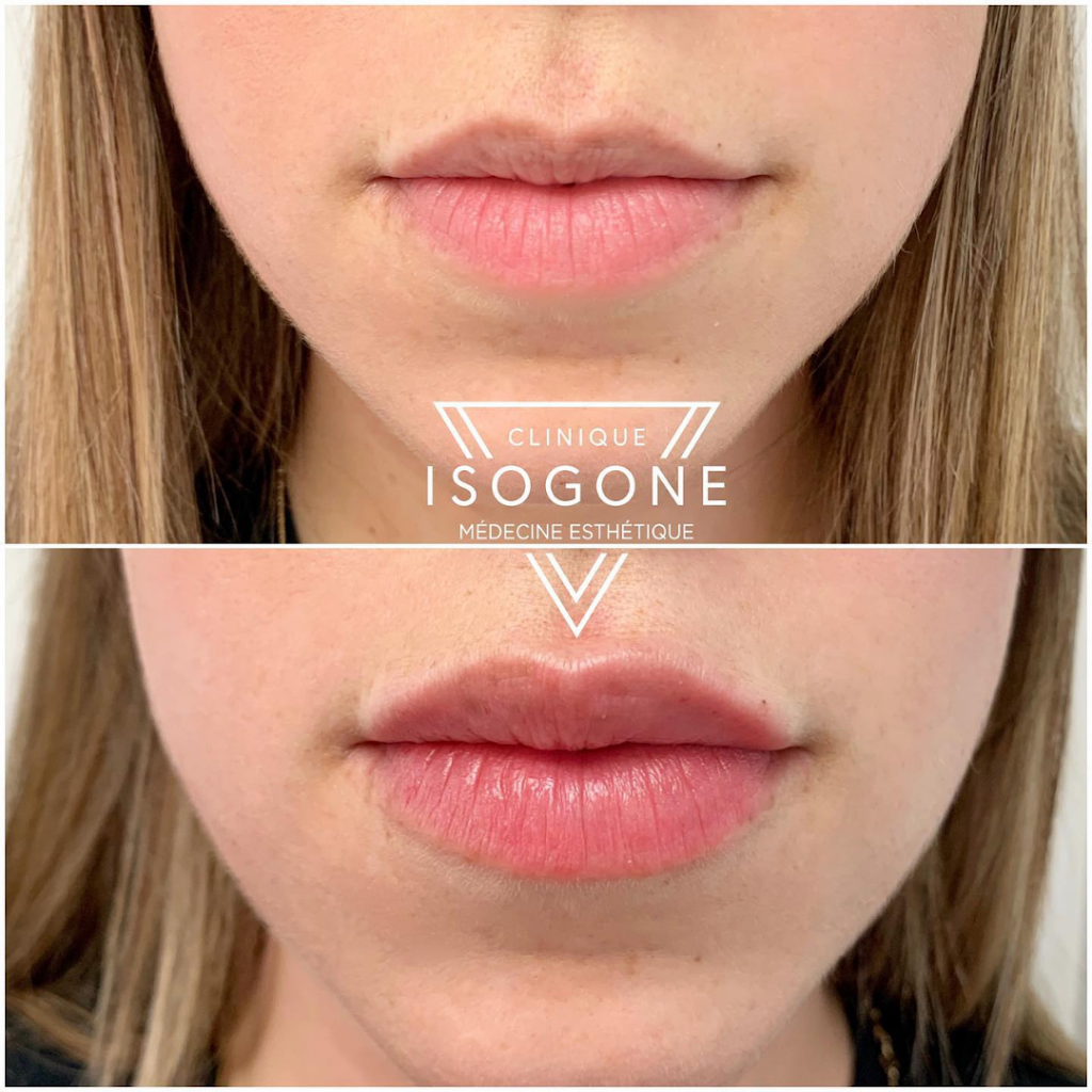 Clinique Isogone Médico-Esthétique | 1435 Boulevard Saint-Martin O Suite 502, Laval, QC H7S 2C6, Canada | Phone: (450) 667-6676